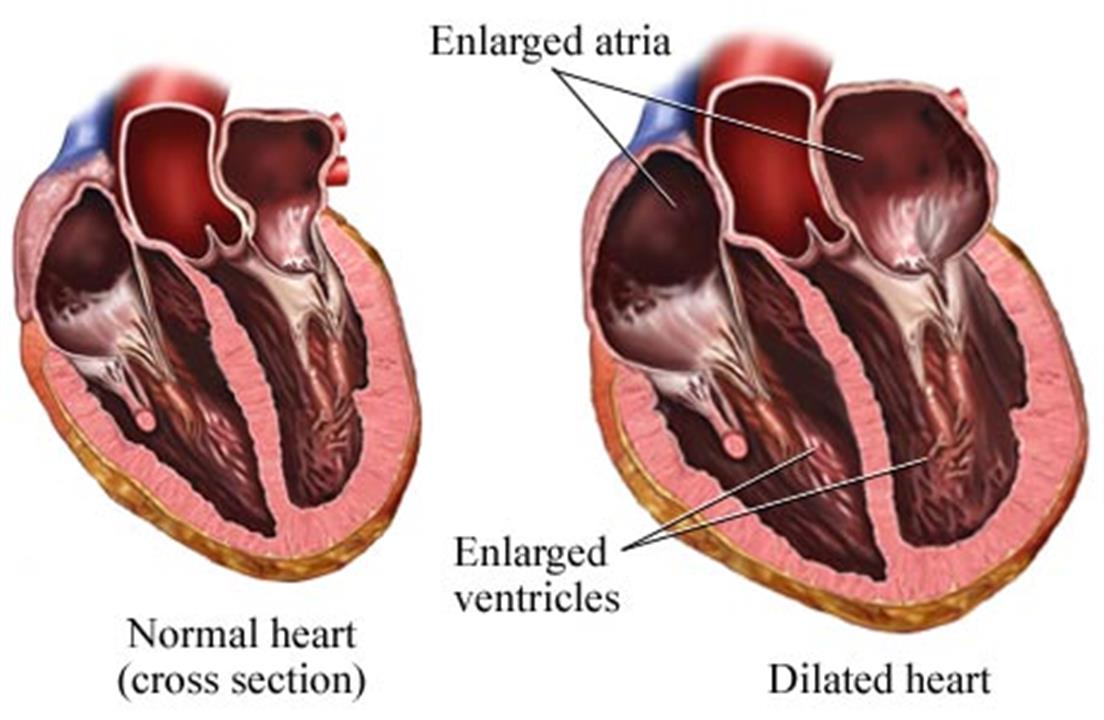 Желудочка сердца расширена. Что такое расширенная полость сердца. Расширение полостей сердца. Утолщение стенок сердца.