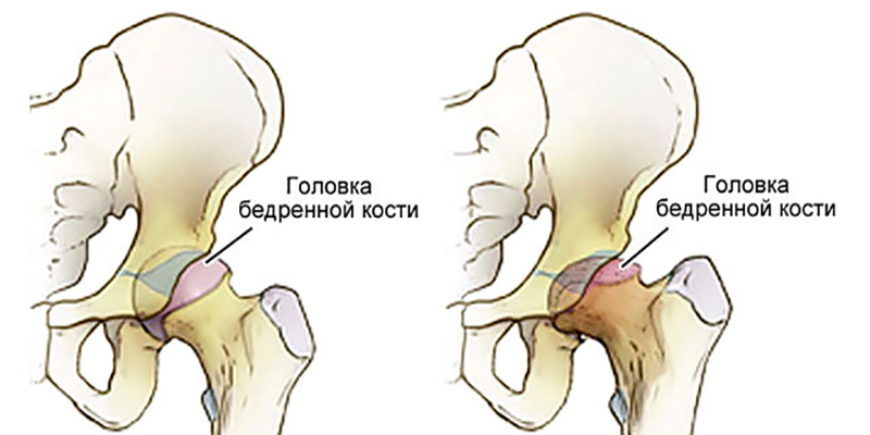 Асептический некроз головки бедренной кости (остеохондропатия или болезнь Лега-Кальве-Пертесса)